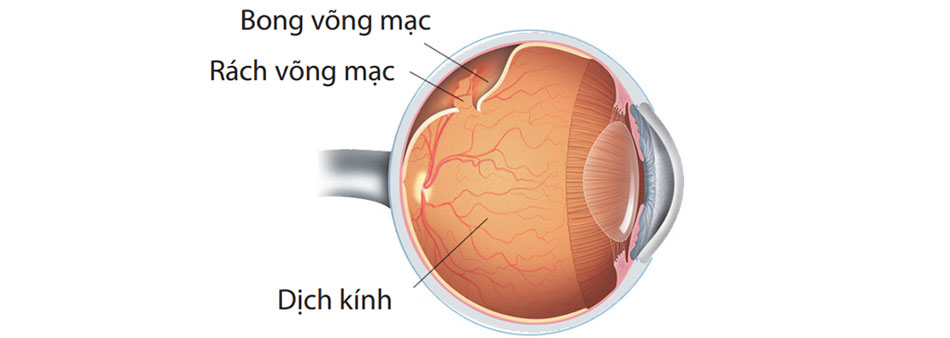 BONG VÕNG MẠC LÀ GÌ? NHỮNG ĐIỀU CẦN BIẾT VỀ BONG VÕNG MẠC